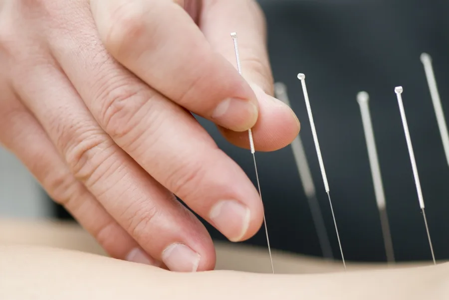Medical acupuncture and dry needling