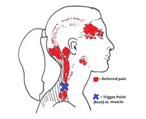 Trigger Points And Trigger Point Dry Needling Medical Acupuncture Spine Plus