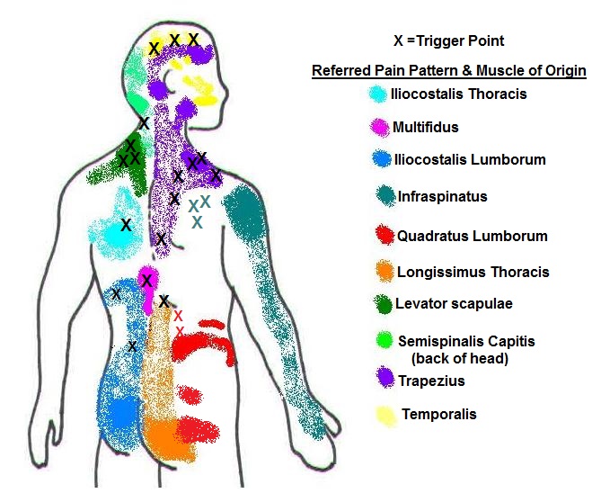 Referred Pain Chart Anatomy