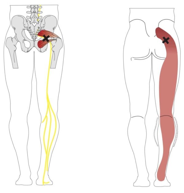 3_Piriformis_Syndrome_EPS | Spine Plus