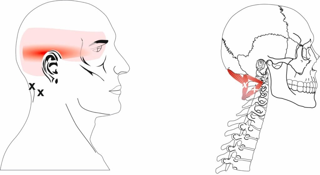 Tension Headaches | Spine Plus